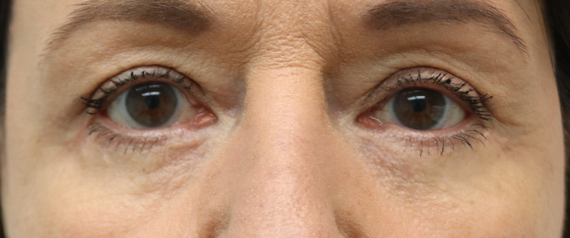 Blepharoplasty Before and After 01