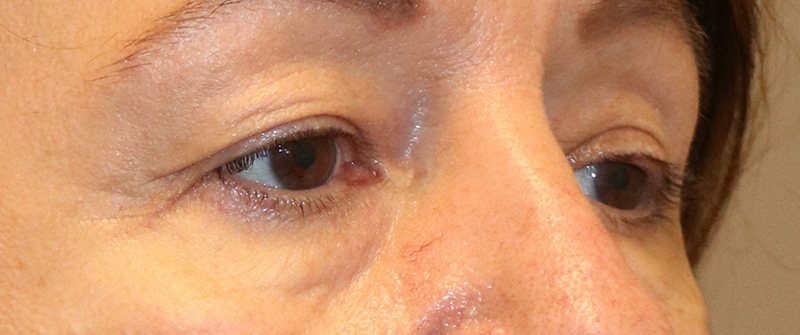 Blepharoplasty Before and After 02