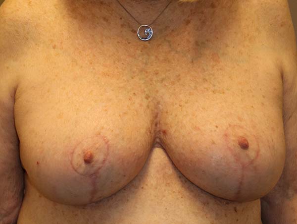 Breast Augmentation Before and After 13