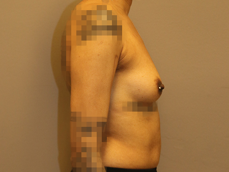 Breast Augmentation Before and After 10