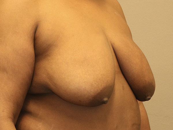 Breast Augmentation Before and After 19