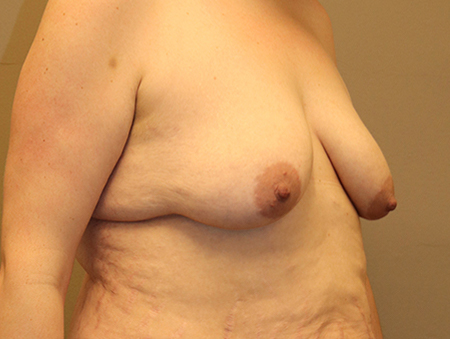 Breast Augmentation Before and After 21