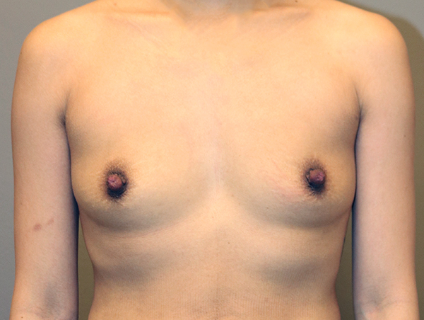 Breast Augmentation Before and After 25