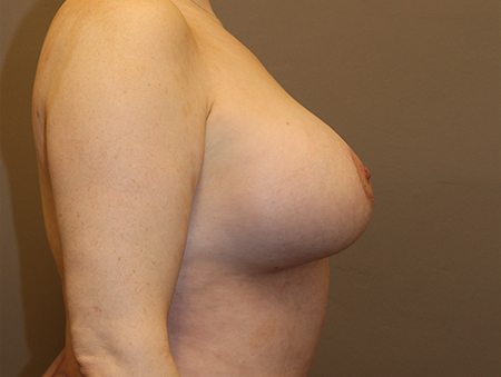 Breast Augmentation Before and After 28