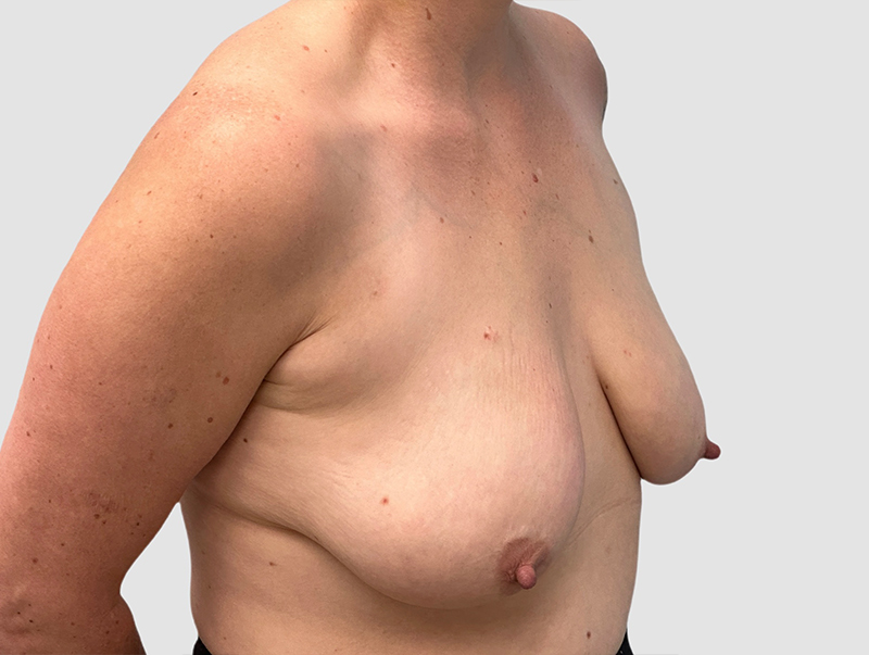 Breast Augmentation Before and After 30