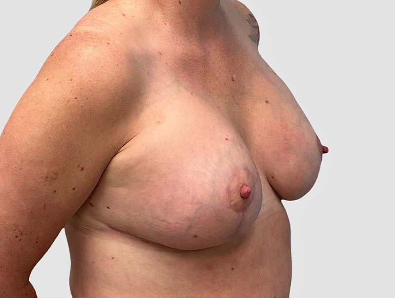 Breast Augmentation Before and After 30