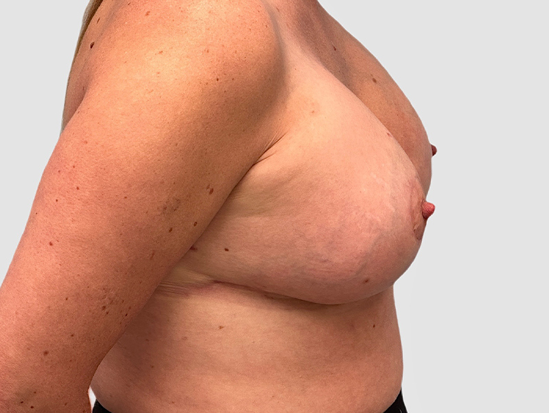 Breast Augmentation Before and After 30