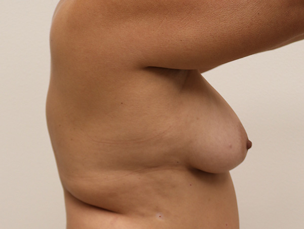 Breast Fat Transfer Before and After 01