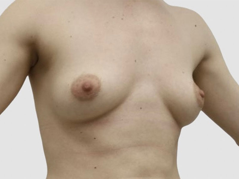 Breast Fat Transfer Before and After 05