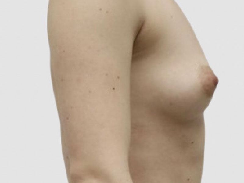Breast Fat Transfer Before and After 05