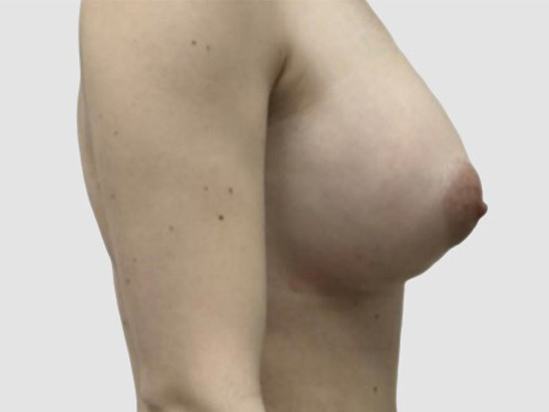 Breast Fat Transfer Before and After 05