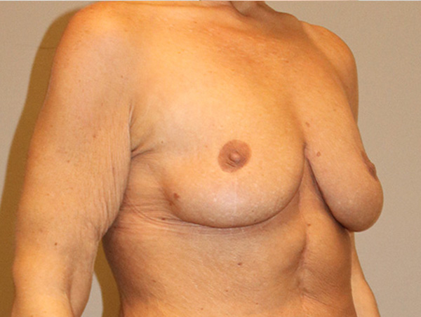 Breast Lift Before and After 10