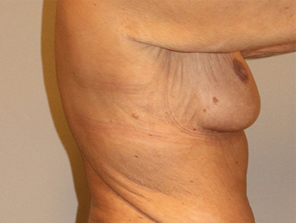 Breast Lift Before and After 10