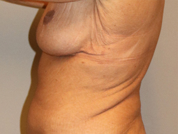 Breast Lift Before and After 10