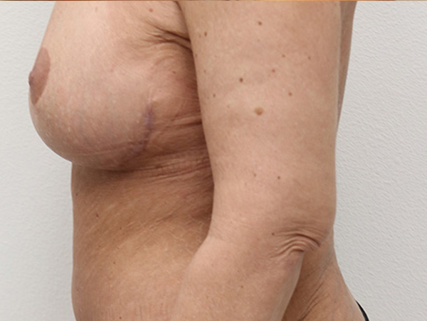 Breast Lift Before and After 10