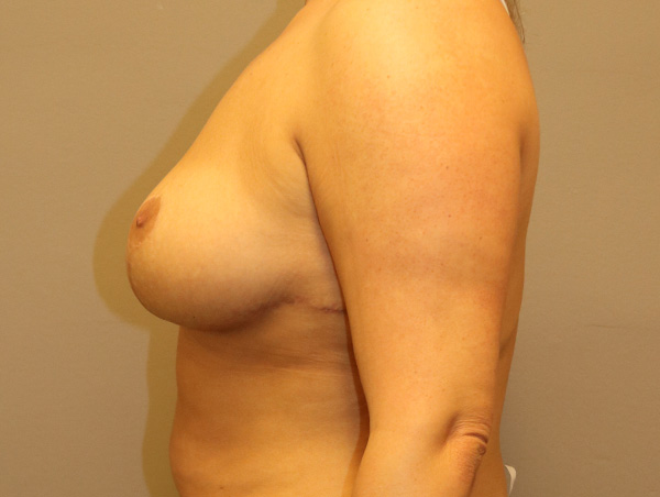 Breast Lift Before and After 11