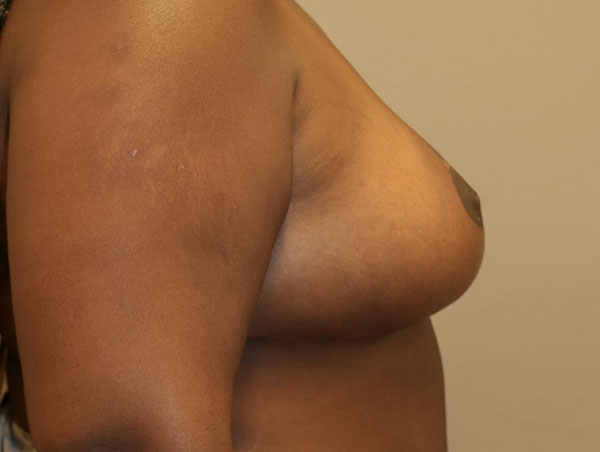 Breast Lift Before and After 14