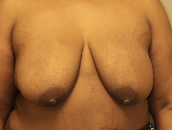 Breast Lift Before and After 20
