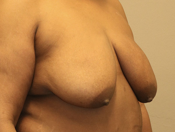 Breast Lift Before and After 20