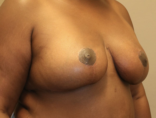 Breast Lift Before and After 20