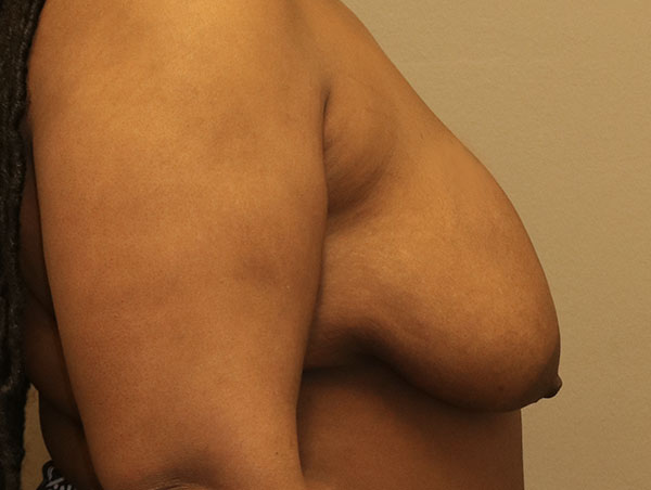 Breast Lift Before and After 20