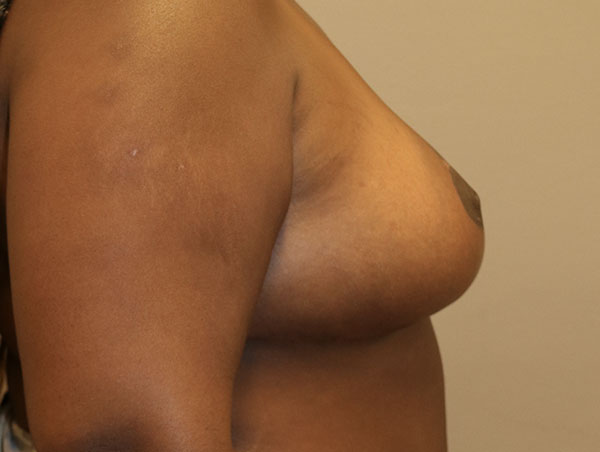 Breast Lift Before and After 20