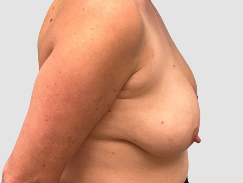 Breast Lift Before and After 24