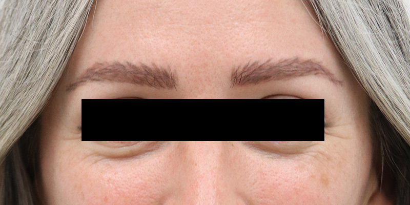Brow Lift Before and After 01