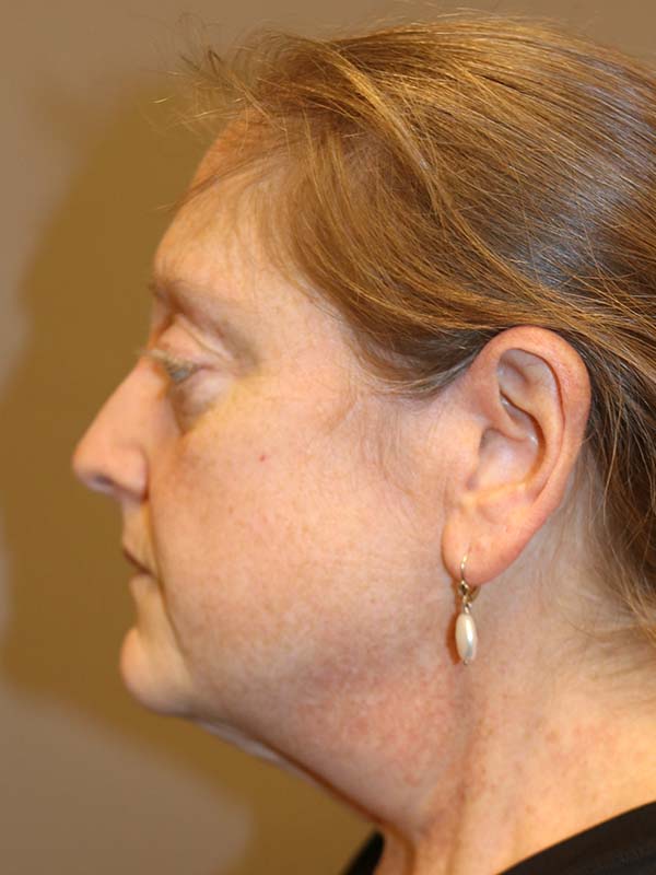 Facelift Before and After 01