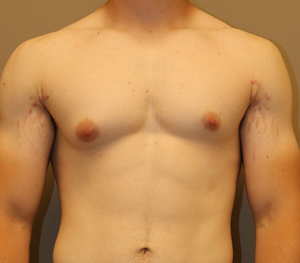 Gynecomastia Before and After 02