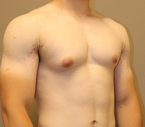 Gynecomastia Before and After 02