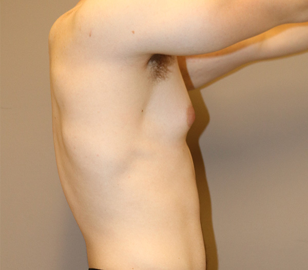 Gynecomastia Before and After 02