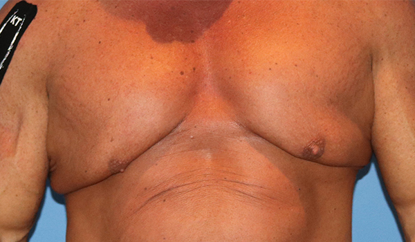 Gynecomastia Before and After 03