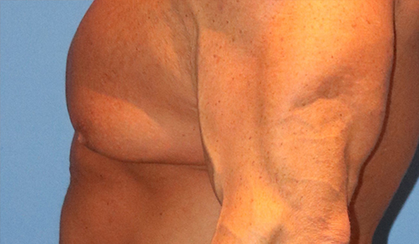 Gynecomastia Before and After 03