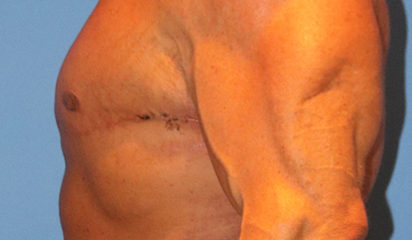 Gynecomastia Before and After 03