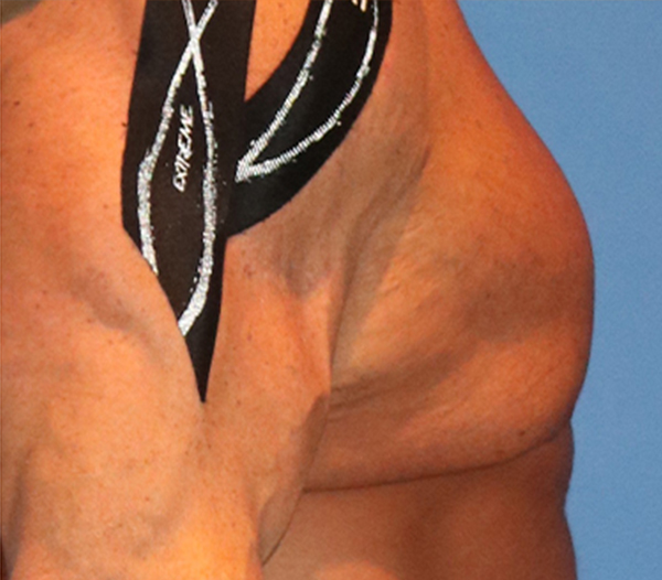 Gynecomastia Before and After 03