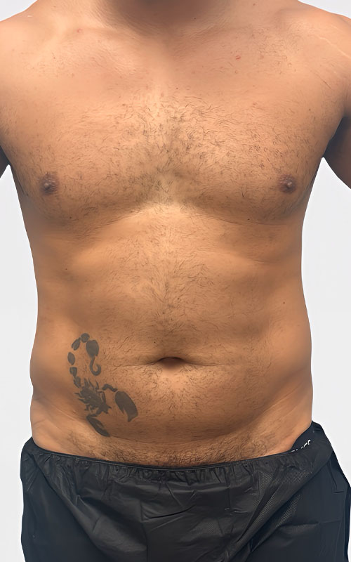 Liposuction Before and After 02