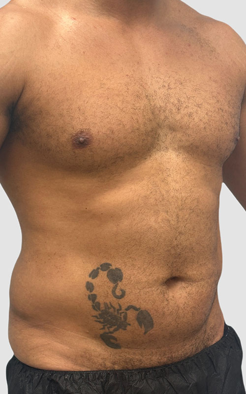 Liposuction Before and After 02