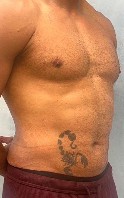 Liposuction Before and After 02