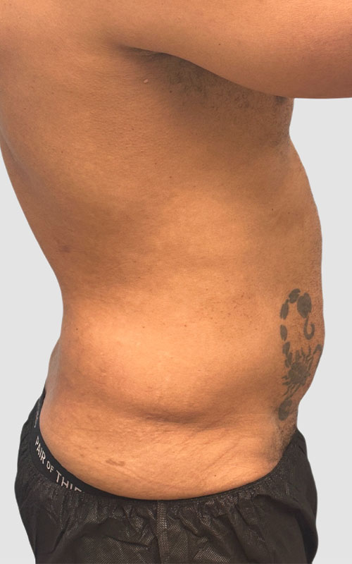 Liposuction Before and After 02