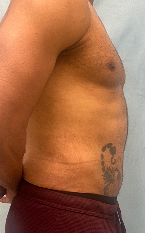 Liposuction Before and After 02