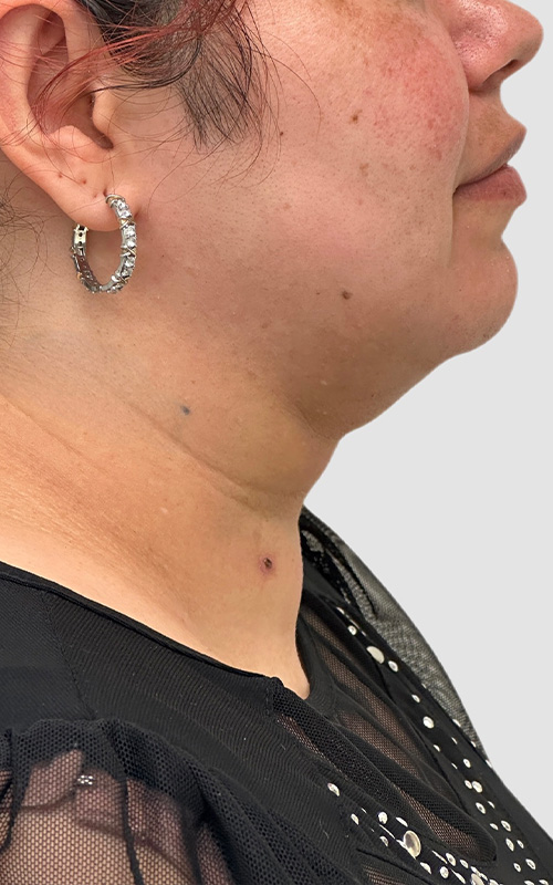 Liposuction Before and After 06