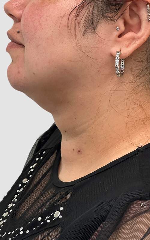 Liposuction Before and After 06