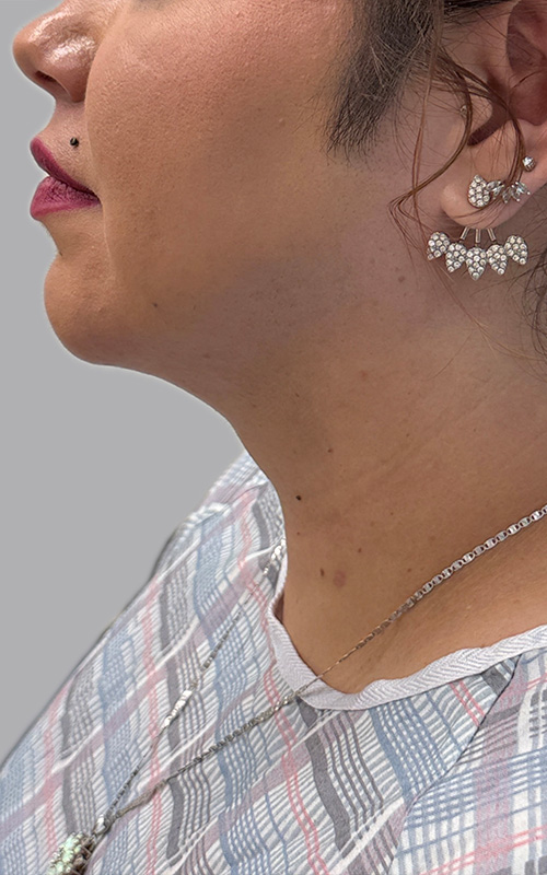 Liposuction Before and After 06