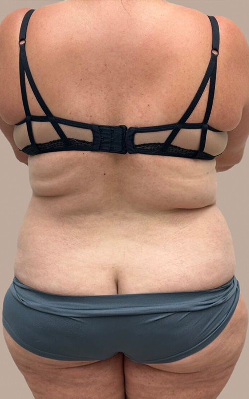 Liposuction Before and After 06