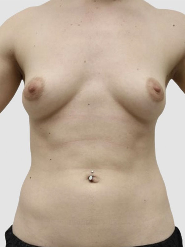 Liposuction Before and After 13