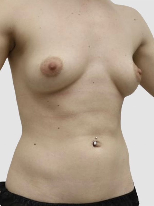 Liposuction Before and After 13