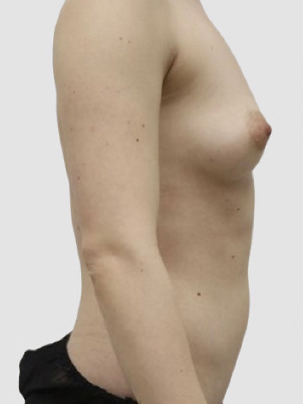 Liposuction Before and After 13