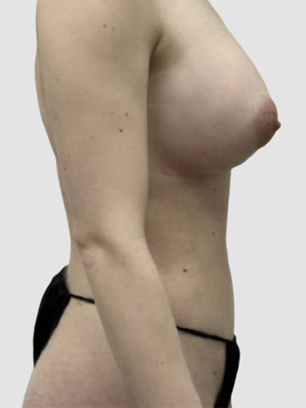 Liposuction Before and After 13