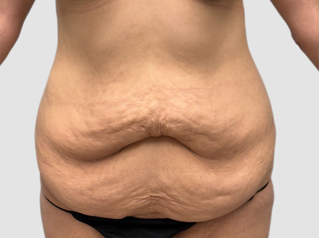 Liposuction Before and After 14